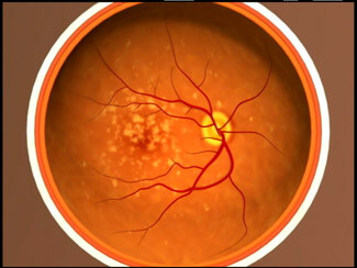 macular-degeneration